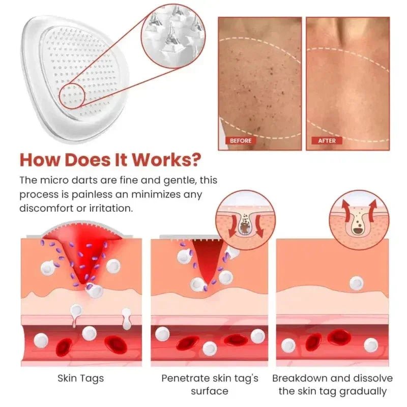 Derma Smooth Skin Tag Removal Patch - Trends Nest
